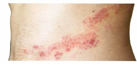 全面介绍带状疱疹的临床表现、病因学、诊断方法、急性与长期治疗方案及预防接种建议,帮助不同人群识别风险、科学应对并在必要时寻求专业皮肤科远程或现场治疗
