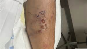 近期美国路易斯安那州发生一起罕见的食肉细菌感染病例,导致第五名患者不幸去世。该细菌通常在温暖的沿海水域繁殖,易于感染免疫力较弱的群体。官方呼吁公众尤其是沿海地区居民及游客采取有效预防措施,避免感染此类致命细菌。本文详尽介绍食肉细菌的危害、传播途径、防护建议及最新疫情动态,帮助读者深刻认识风险,提高防范意识。
