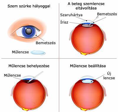 了解白内障手术的过程、术后护理要点及饮食建议,有效促进眼部恢复,预防并发症,保障视力健康。通过科学的护理与生活方式调整,帮助患者尽快恢复清晰视力。
