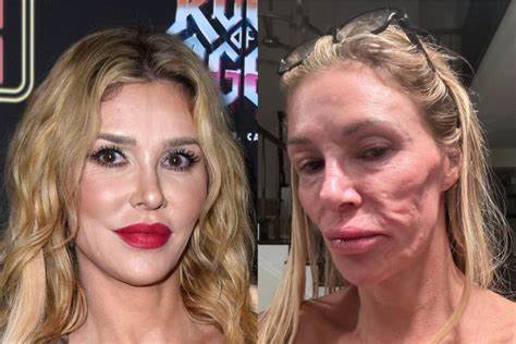 近日,前《真实主妇》明星Brandi Glanville在采访中爆料称,她的乳房植入手术可能导致面部寄生虫感染。本文将深入分析这一医疗事件,探讨医美手术潜在风险,并提供专家建议,帮助读者了解如何安全选择医美项目。
