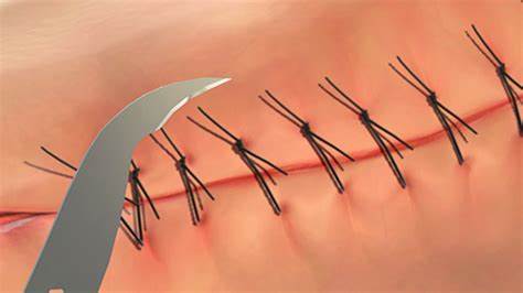 缝线拆除是外科治疗后不可忽视的重要环节。了解缝线拆除的正确流程、相关医疗服务的选择以及一些实用的护理建议,有助于避免伤口感染和并发症,确保伤口尽快恢复。
