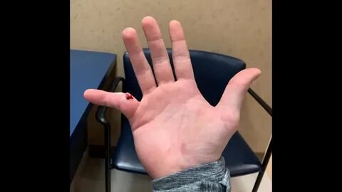 探讨NBA球星德怀特·霍华德在比赛中摔断手指的具体经过,结合医学专家分析伤情严重程度,并提供专业康复建议,帮助球迷和运动爱好者了解手指骨折的预防与治疗方法。
