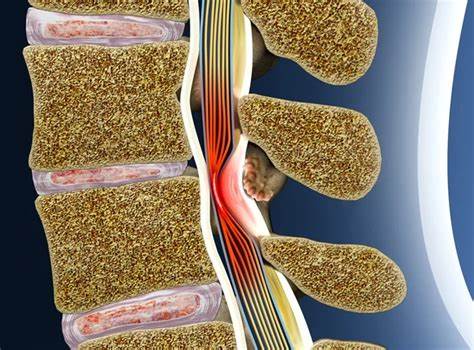 揭示脊柱融合等高风险手术频繁发生的原因与后果,解析影像学与症状不一致、经济激励和设备产业影响,提供基于证据的替代治疗与术前评估要点,帮助患者与家属在复杂医疗决策中做出更清晰、更安全的选择。
