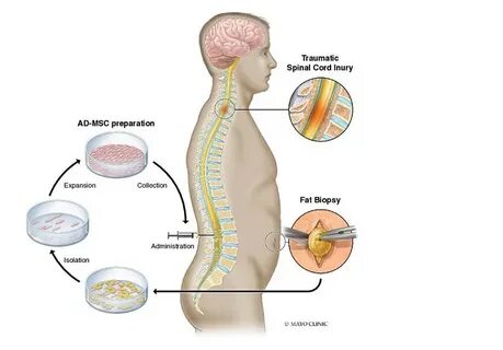 梅奥诊所最新研究显示,干细胞疗法在脊髓损伤患者中的应用安全有效,为该领域治疗提供了新的希望。本文深入探讨研究背景、实验过程及未来展望,帮助读者全面了解这一医学突破。
