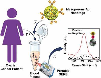 卵巢癌作为女性致死率较高的癌症之一,早期诊断至关重要。基于介孔金纳米结构的等离激元增强拉曼散射(SERS)生物传感技术,通过精准识别胞外囊泡中的生物标志物,为卵巢癌的无创检测提供了革命性解决方案。该技术凭借其高灵敏度和特异性,显示出在临床诊断和疾病监测中的广阔应用前景。
