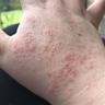瘙痒性水泡性皮疹的12种常见原因及应对方法
