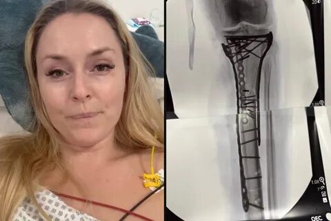 林赛·冯恩在社交媒体上公开其奥运会期间严重受伤的CT影像和诊断报告,引发广泛关注。本文深入探讨这位传奇滑雪运动员的伤病经历,分析医学影像技术在体育伤害诊断中的重要性,并探讨运动员健康与职业生涯的平衡。
