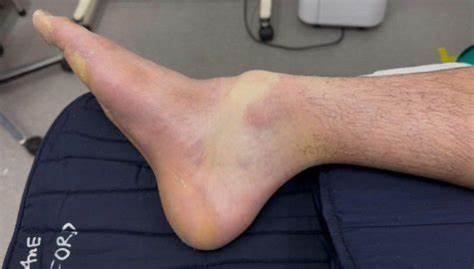 羽毛球运动因其高强度和快速反应特性,容易导致腿部骨折等严重伤害。FV医院的专家分析了常见的错误行为,并提供了预防和康复建议,帮助球员减少伤害风险。
